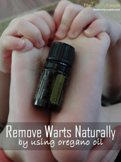 remove-warts-naturally-by-using-oregano-oil-clone